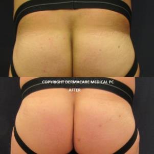 sculptra butt lift before and after